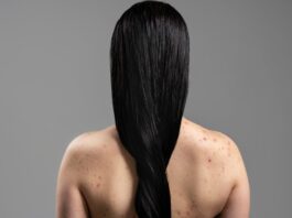 Get Rid Of Body Acne Before Your D-Day Get Rid Of Body Acne - Wedding Affair