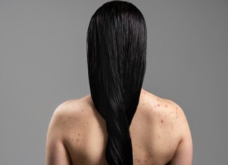 Get Rid Of Body Acne Before Your D-Day Get Rid Of Body Acne - Wedding Affair